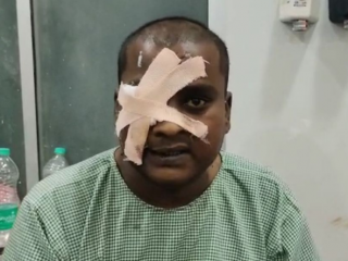 ಬ್ಲ್ಯಾಕ್ ಫಂಗಸ್‍ನಿಂದ ಕಣ್ಣು ಕಳೆದುಕೊಂಡ ವ್ಯಕ್ತಿ