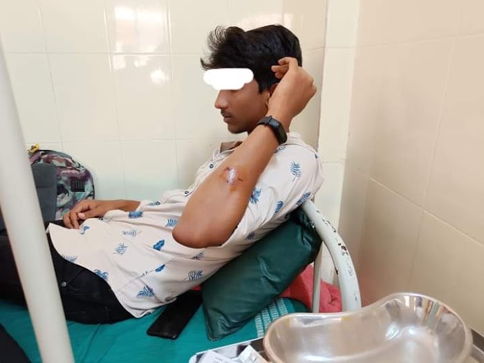 ಪರೀಕ್ಷೆಯಲ್ಲಿ ನಕಲು ಮಾಡುತ್ತಿದ್ದ ಎಂದು ವಿದ್ಯಾರ್ಥಿಯ ಕೈ ಕಚ್ಚಿದ ಉಪನ್ಯಾಸಕ