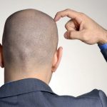 man bald (1)