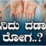 ಮಧ್ಯಪ್ರದೇಶದಲ್ಲಿ ದಡಾರದಿಂದ ಇಬ್ಬರು ಕಂದಮ್ಮಗಳ ದುರ್ಮರಣ- ಏನಿದು ರೋಗ?, ಲಕ್ಷಣಗಳೇನು?, ತಡೆಗಟ್ಟೋದು ಹೇಗೆ?