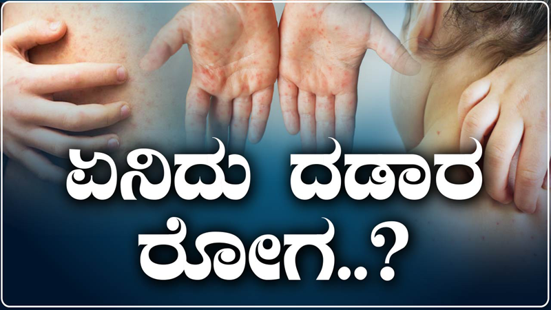 ಮಧ್ಯಪ್ರದೇಶದಲ್ಲಿ ದಡಾರದಿಂದ ಇಬ್ಬರು ಕಂದಮ್ಮಗಳ ದುರ್ಮರಣ- ಏನಿದು ರೋಗ?, ಲಕ್ಷಣಗಳೇನು?, ತಡೆಗಟ್ಟೋದು ಹೇಗೆ?