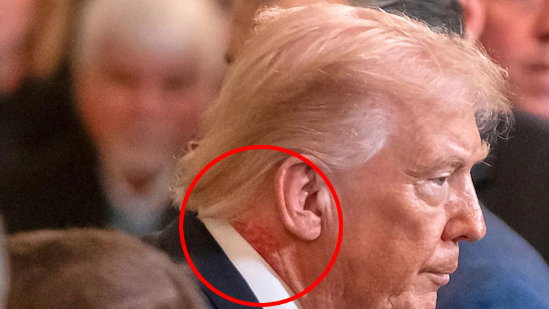 ಯುದ್ಧದ ಮಧ್ಯೆ ಟ್ರಂಪ್ಗೆ ಕಾಡ್ತಿದೆಯಾ ಚರ್ಮರೋಗ? - ಫೋಟೋ ವೈರಲ್ 2 Donald Trump