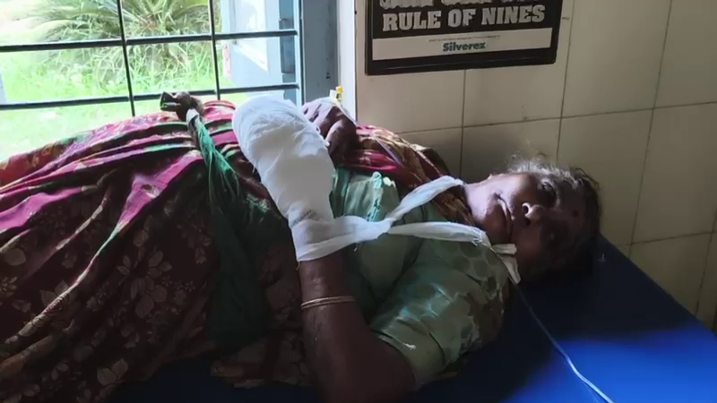 Crude bomb explosion in Thirthahalli Elderly woman seriously injured